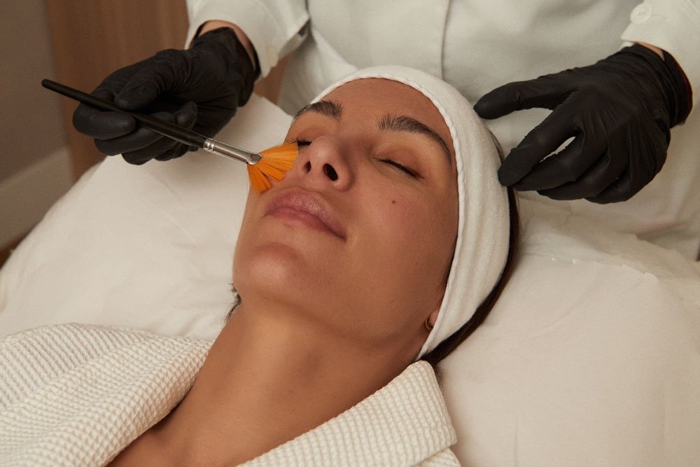 Peeling Químico