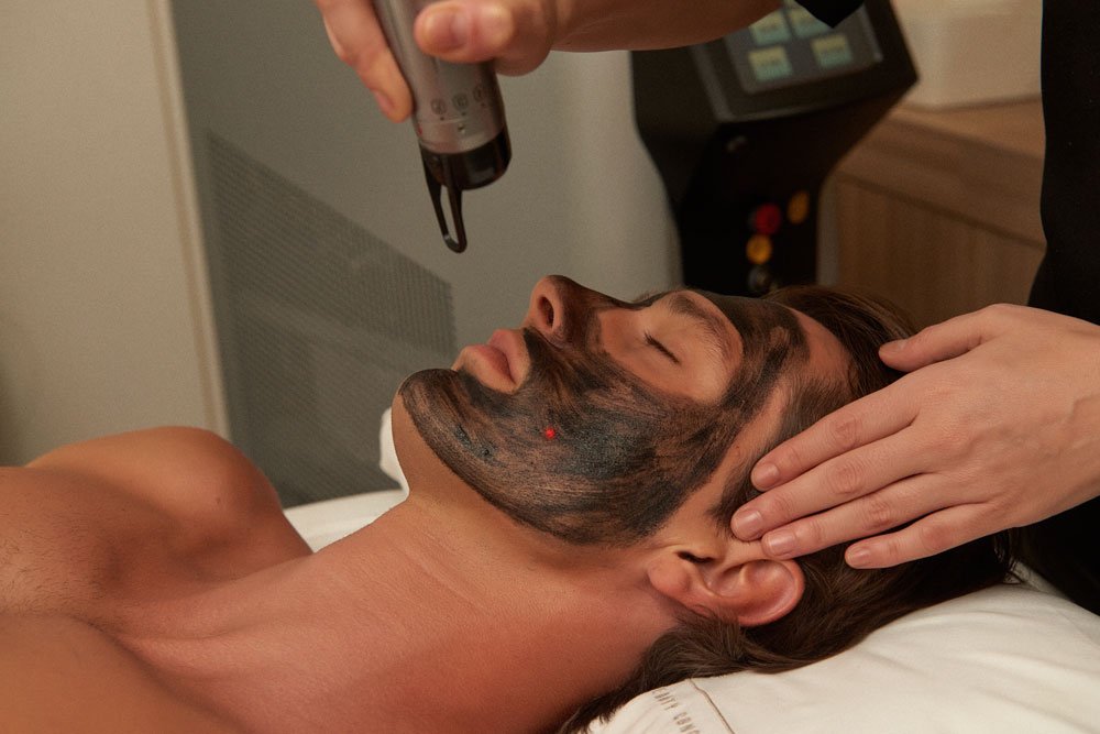 Carbon Peel By Alma Q